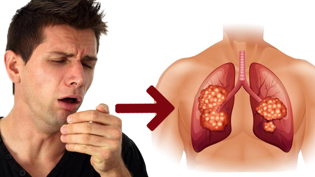 T&ocirc;i c&oacute; bị ho m&atilde;n t&iacute;nh kh&ocirc;ng? C&aacute;c triệu chứng, điều trị v&agrave; hơn thế nữa