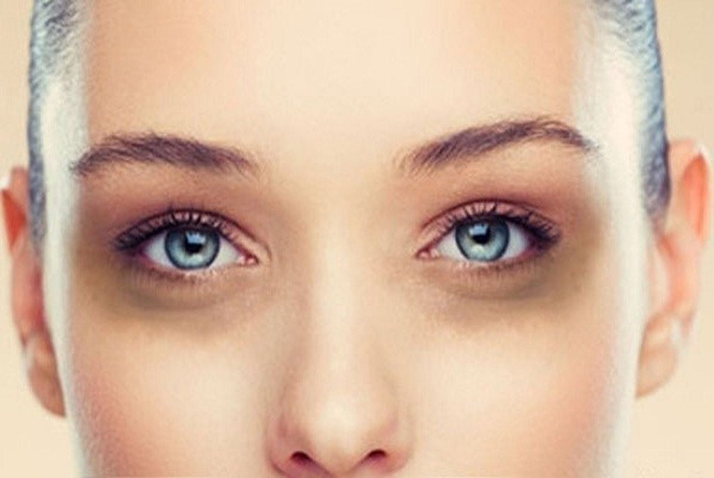 S&aacute;u điều bạn cần biết về t&igrave;nh trạng th&acirc;m quầng mắt
